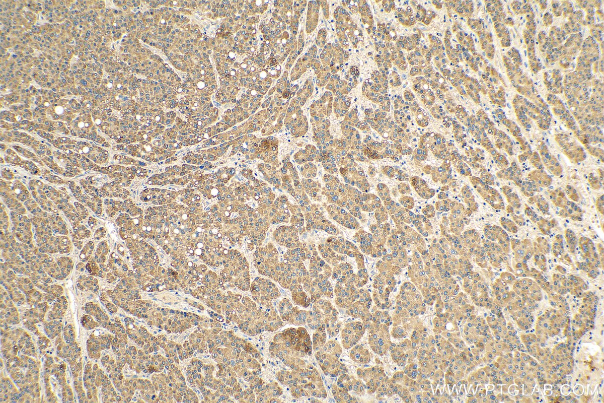 Immunohistochemistry (IHC) staining of human liver cancer tissue using RALGAPB Polyclonal antibody (28330-1-AP)