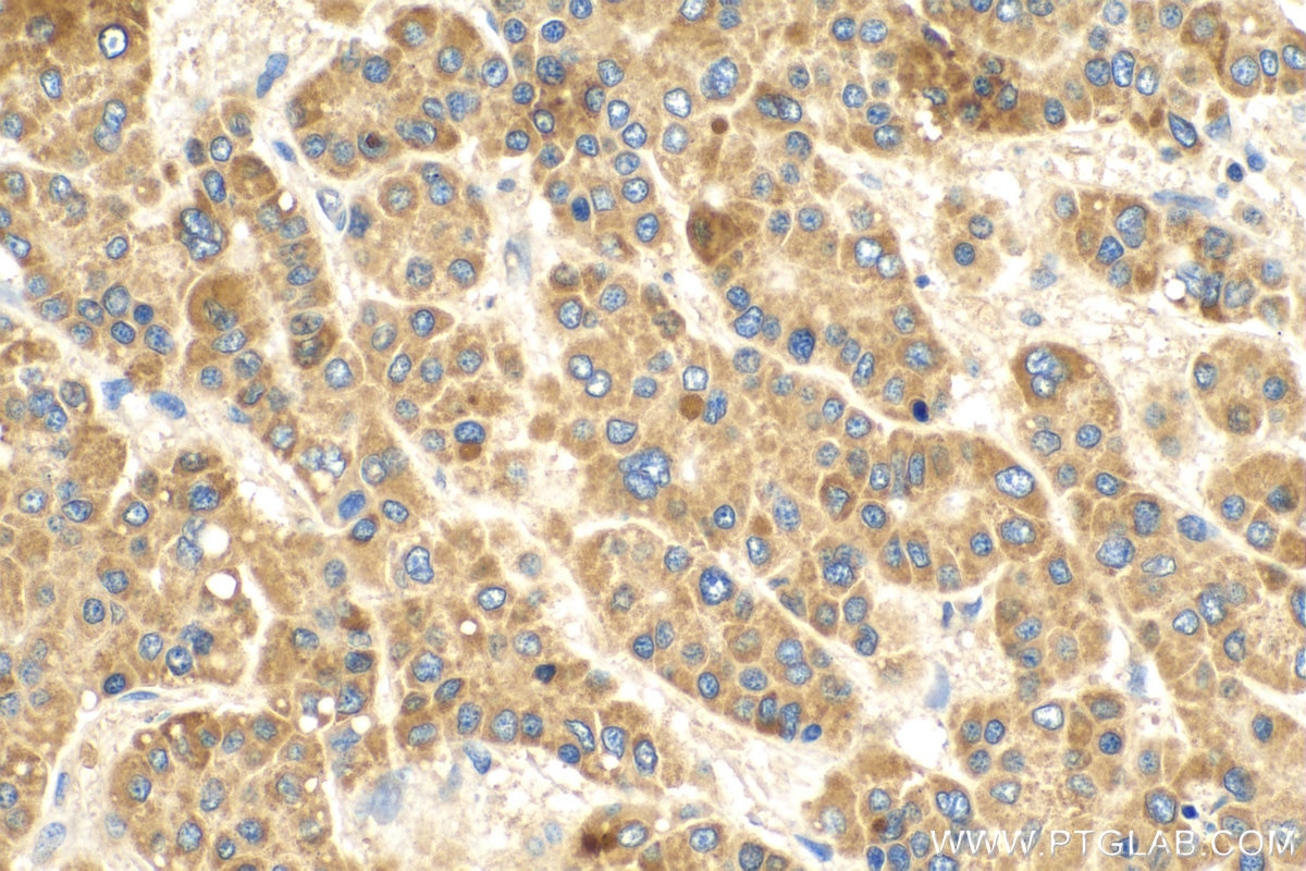 Immunohistochemistry (IHC) staining of human liver cancer tissue using RALGAPB Polyclonal antibody (28330-1-AP)