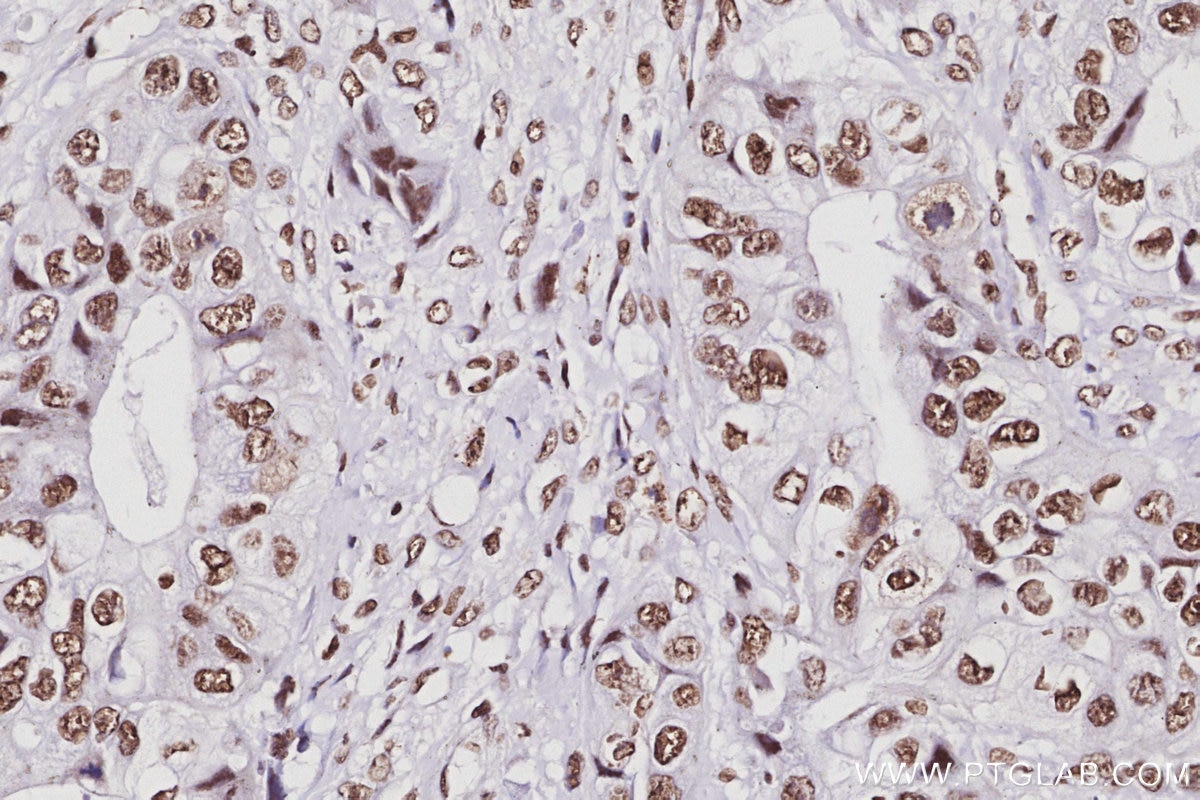 Immunohistochemistry (IHC) staining of human pancreas cancer tissue using RALY Polyclonal antibody (17896-1-AP)