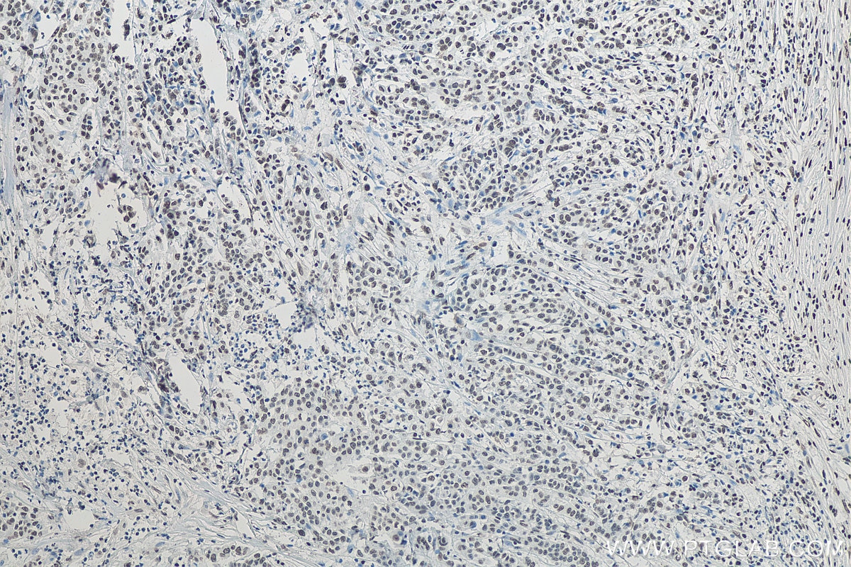 Immunohistochemistry (IHC) staining of human stomach cancer tissue using RALY Monoclonal antibody (68011-1-Ig)