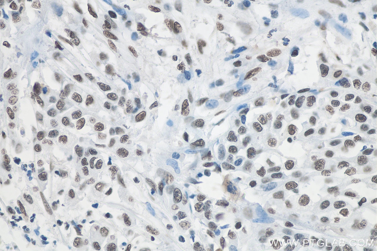 Immunohistochemistry (IHC) staining of human stomach cancer tissue using RALY Monoclonal antibody (68011-1-Ig)