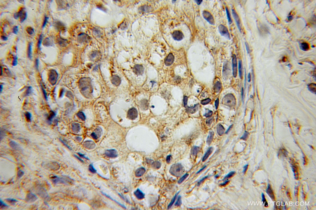 Immunohistochemistry (IHC) staining of human breast cancer tissue using RAMP2 Polyclonal antibody (13223-2-AP)