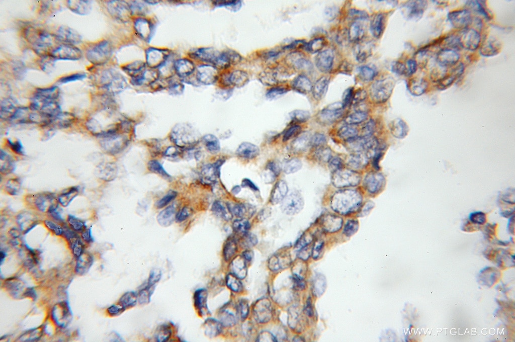 Immunohistochemistry (IHC) staining of human breast cancer tissue using RAMP3 Polyclonal antibody (11861-1-AP)