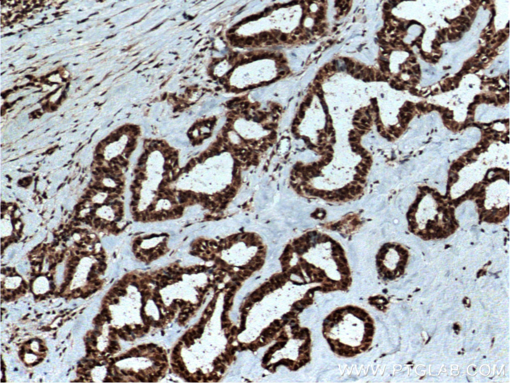 Immunohistochemistry (IHC) staining of human breast cancer tissue using RAN Polyclonal antibody (10469-1-AP)