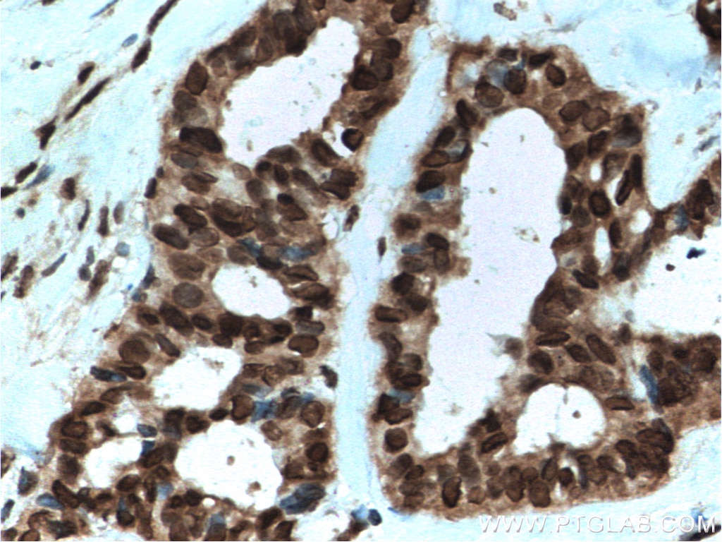 Immunohistochemistry (IHC) staining of human breast cancer tissue using RAN Polyclonal antibody (10469-1-AP)