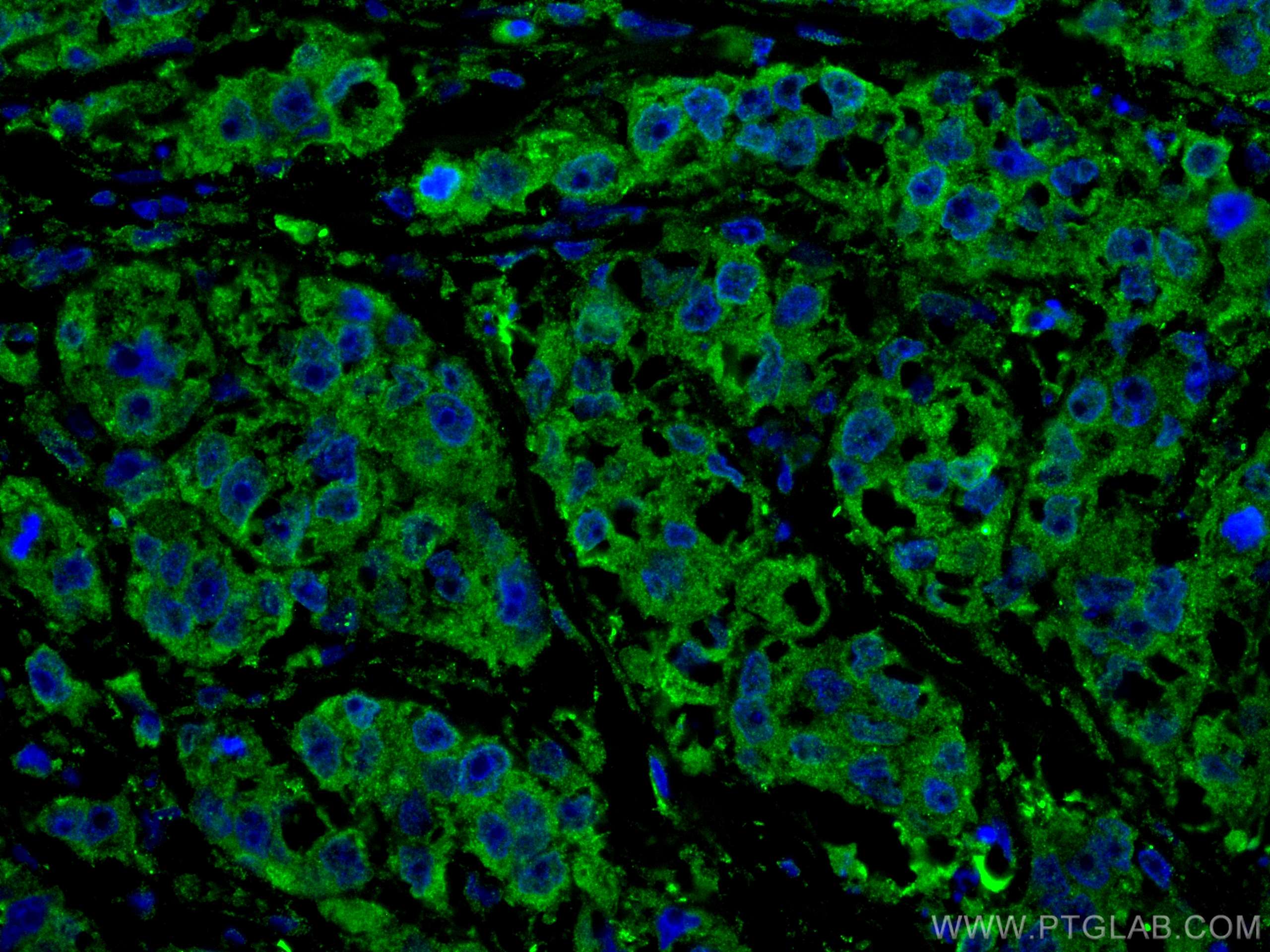 Immunofluorescence (IF) / fluorescent staining of human breast cancer tissue using RAN Monoclonal antibody (67500-1-Ig)