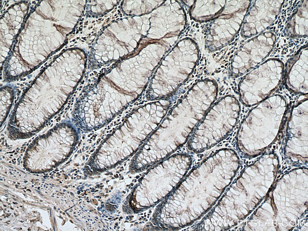 IHC staining of human colon cancer using 67500-1-Ig