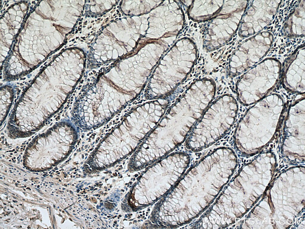 Immunohistochemistry (IHC) staining of human colon cancer tissue using RAN Monoclonal antibody (67500-1-Ig)