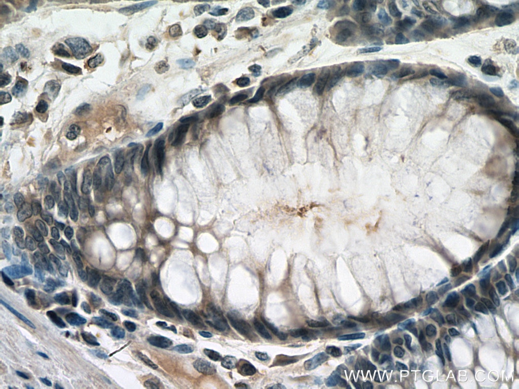 Immunohistochemistry (IHC) staining of human colon cancer tissue using RAN Monoclonal antibody (67500-1-Ig)