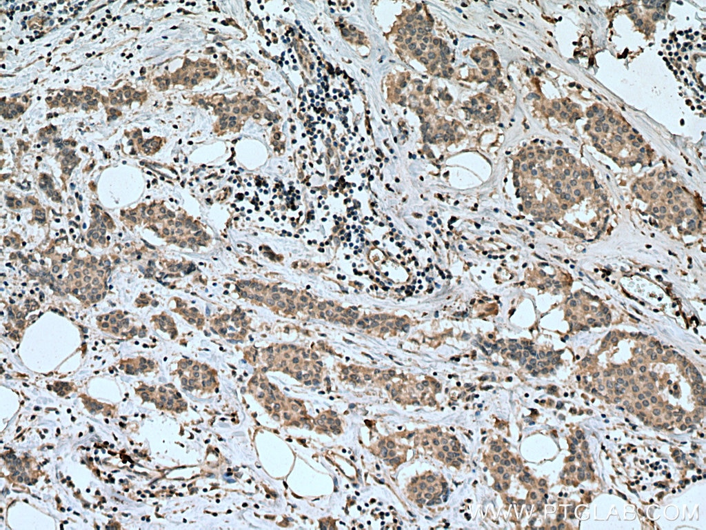 IHC staining of human breast cancer using 67500-1-Ig