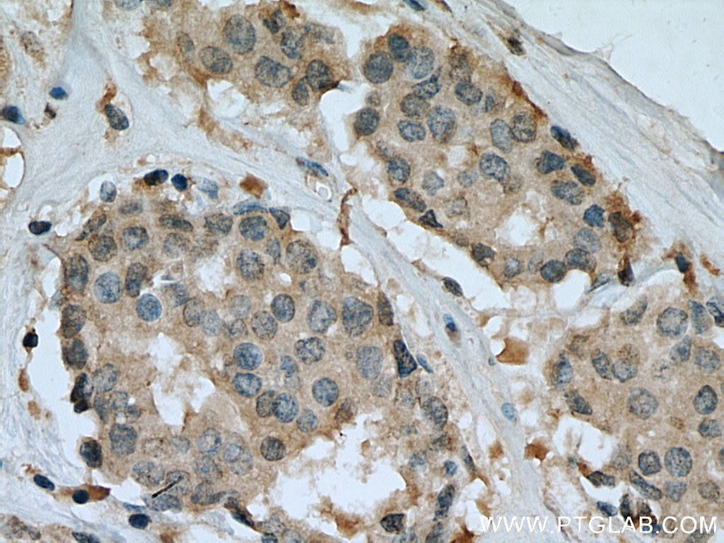 Immunohistochemistry (IHC) staining of human breast cancer tissue using RAN Monoclonal antibody (67500-1-Ig)
