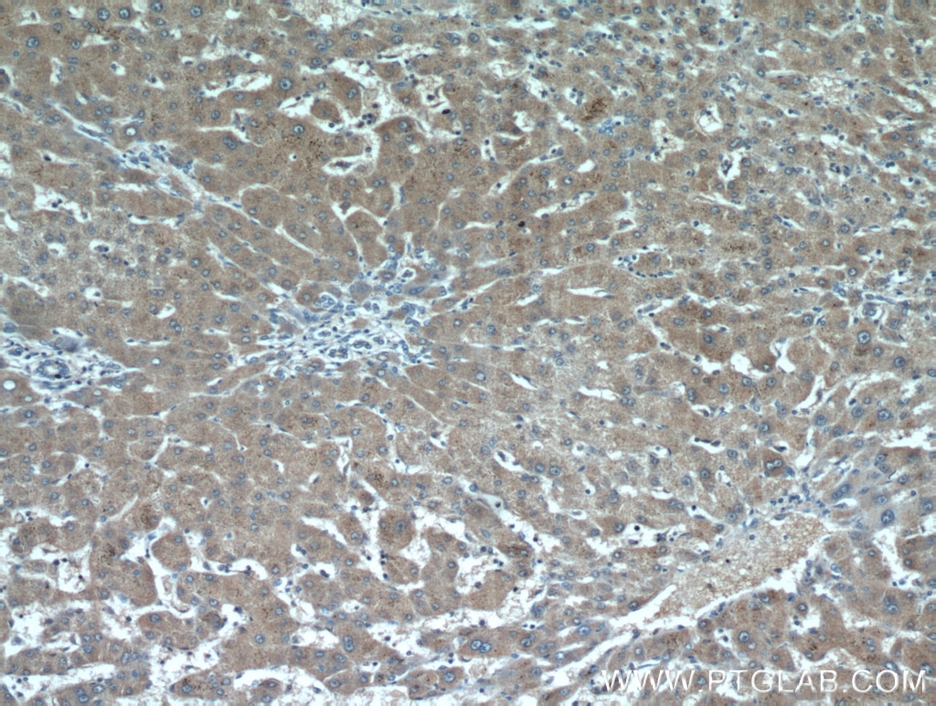 Immunohistochemistry (IHC) staining of human hepatocirrhosis tissue using RANBP10 Polyclonal antibody (21107-1-AP)