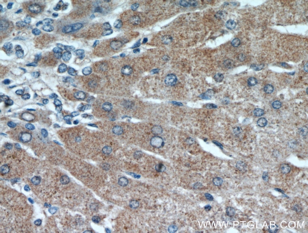 Immunohistochemistry (IHC) staining of human hepatocirrhosis tissue using RANBP10 Polyclonal antibody (21107-1-AP)
