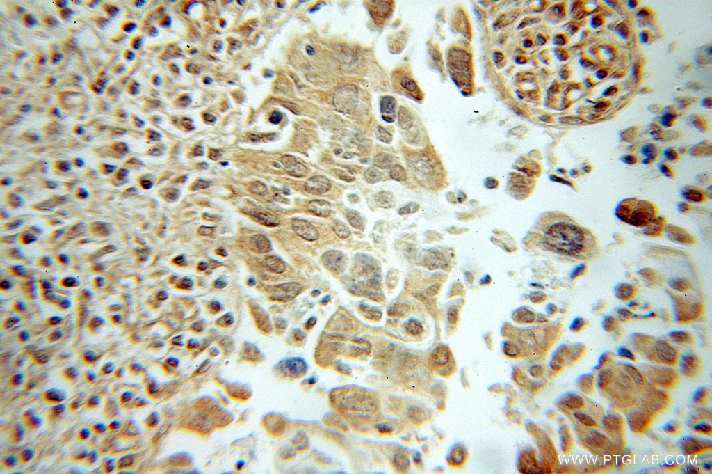 Immunohistochemistry (IHC) staining of human cervical cancer tissue using RANBP9 Polyclonal antibody (51038-1-AP)