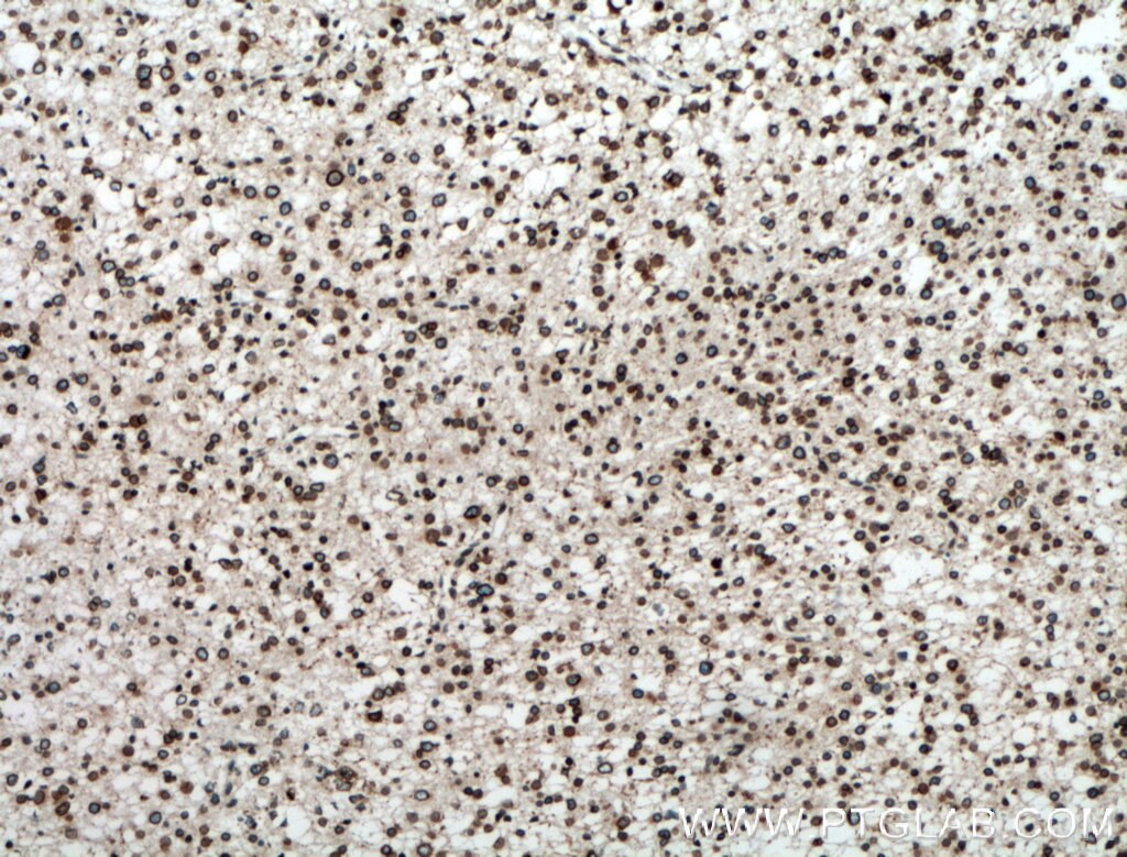 Immunohistochemistry (IHC) staining of human gliomas tissue using RANGAP1 Polyclonal antibody (11102-1-AP)