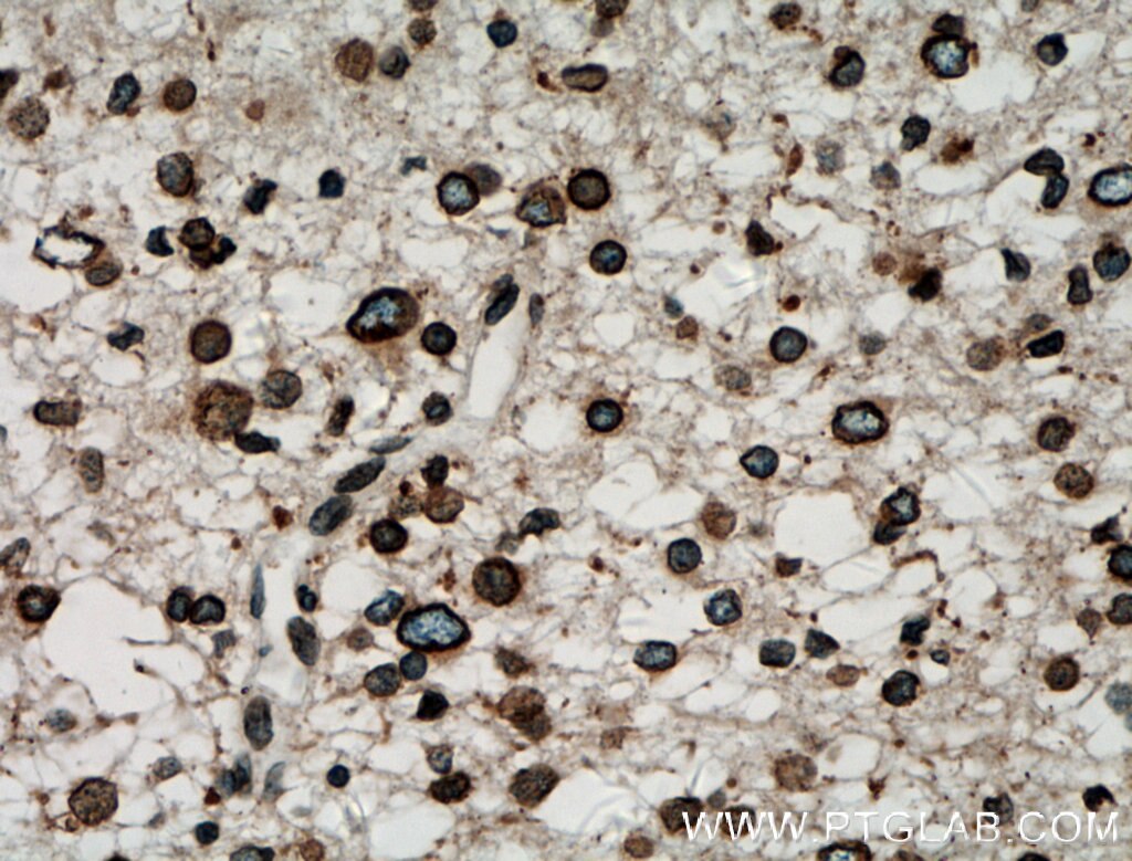 Immunohistochemistry (IHC) staining of human gliomas tissue using RANGAP1 Polyclonal antibody (11102-1-AP)