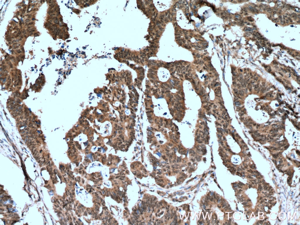 Immunohistochemistry (IHC) staining of human colon cancer tissue using RANGRF Polyclonal antibody (10552-1-AP)