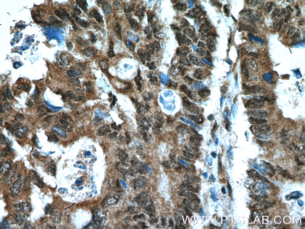 Immunohistochemistry (IHC) staining of human colon cancer tissue using RANGRF Polyclonal antibody (10552-1-AP)