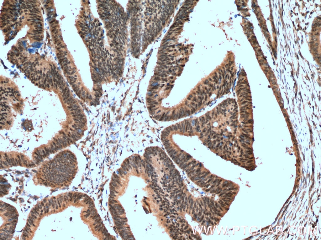 Immunohistochemistry (IHC) staining of human colon cancer tissue using RANGRF Polyclonal antibody (10552-1-AP)