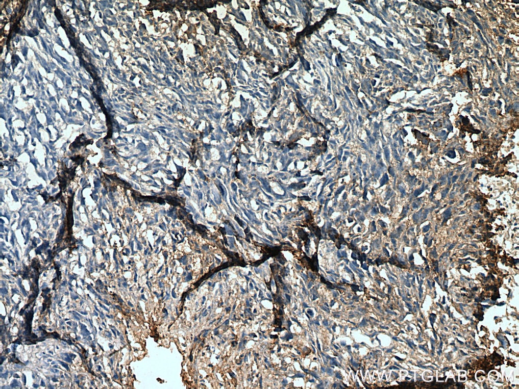 Immunohistochemistry (IHC) staining of human osteosarcoma tissue using RANKL Polyclonal antibody (23408-1-AP)