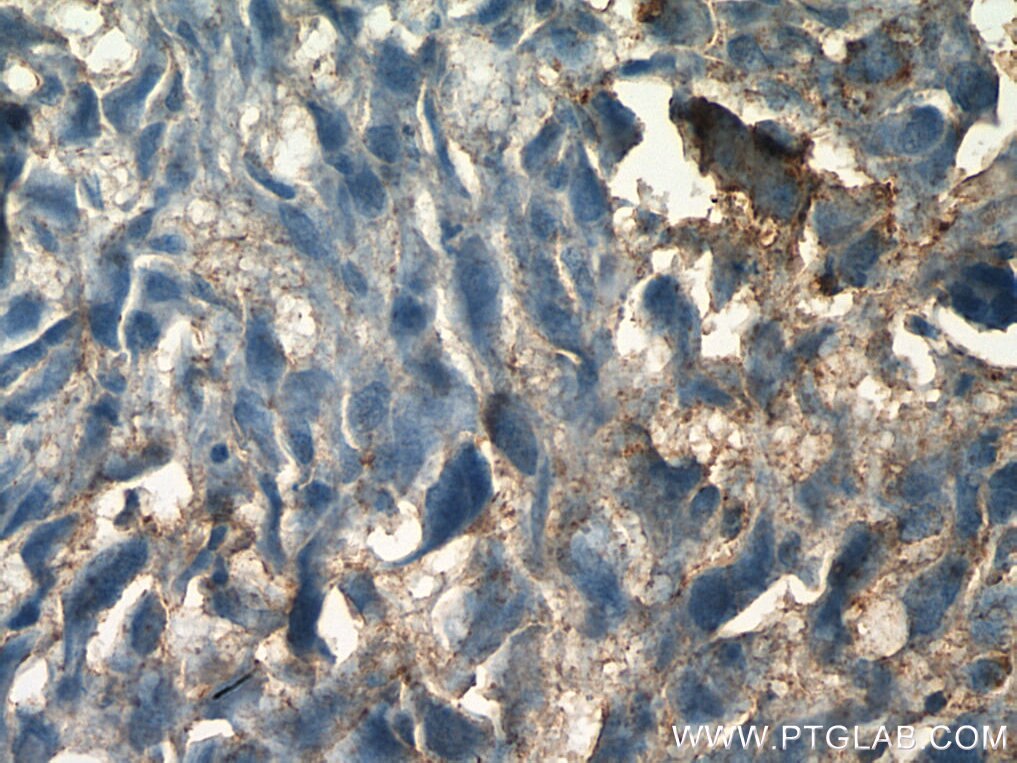 Immunohistochemistry (IHC) staining of human osteosarcoma tissue using RANKL Polyclonal antibody (23408-1-AP)