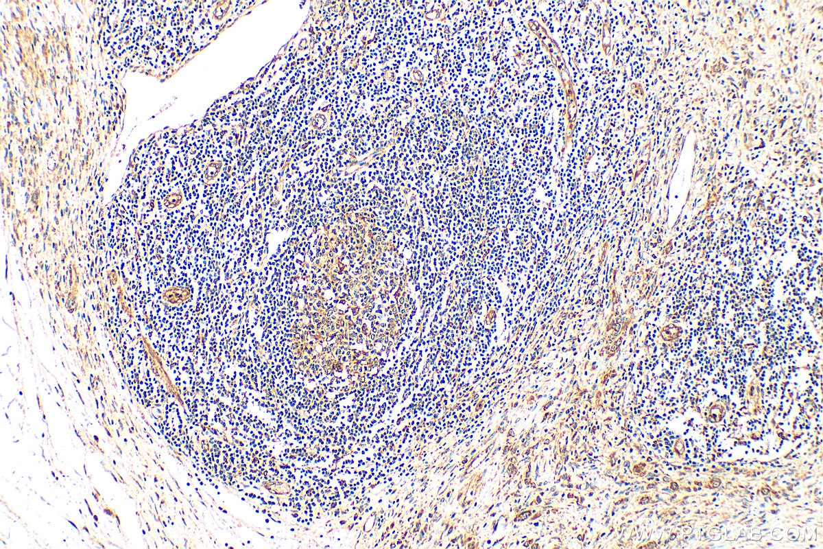 Immunohistochemistry (IHC) staining of human stomach cancer tissue using RANKL Polyclonal antibody (23408-1-AP)
