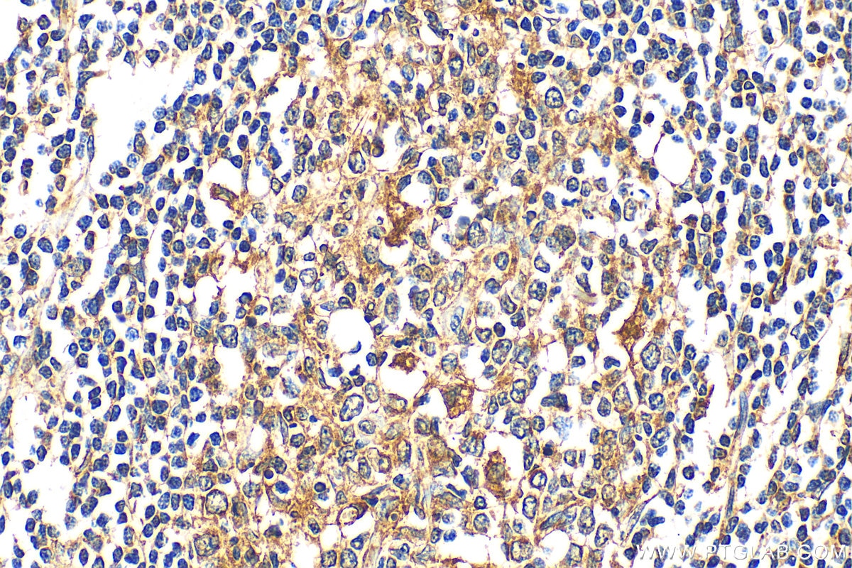 Immunohistochemistry (IHC) staining of human stomach cancer tissue using RANKL Polyclonal antibody (23408-1-AP)