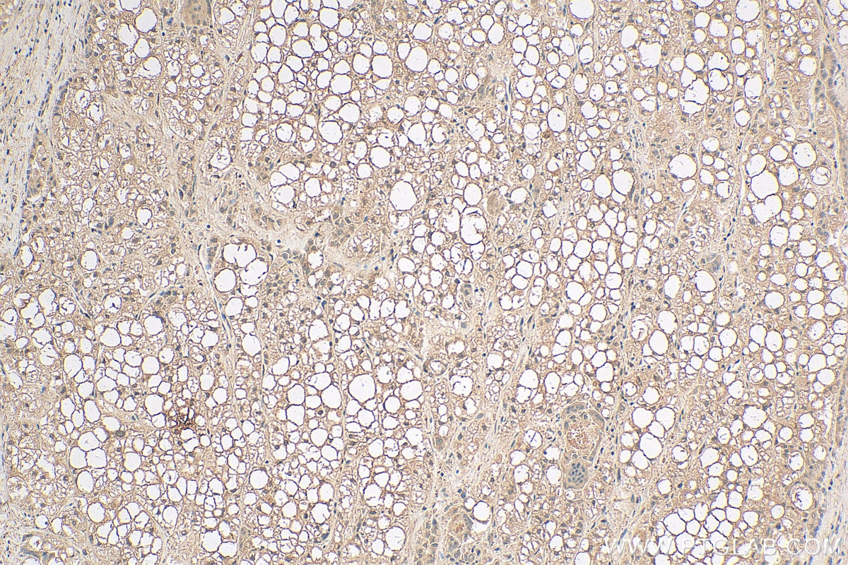 Immunohistochemistry (IHC) staining of human liver cancer tissue using RAP1A Monoclonal antibody (68125-1-Ig)