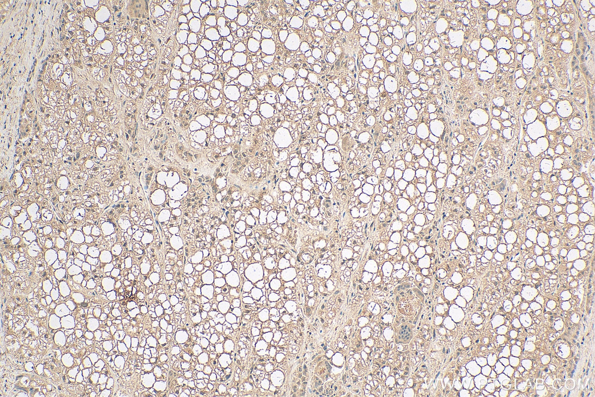 IHC staining of human liver cancer using 68125-1-Ig