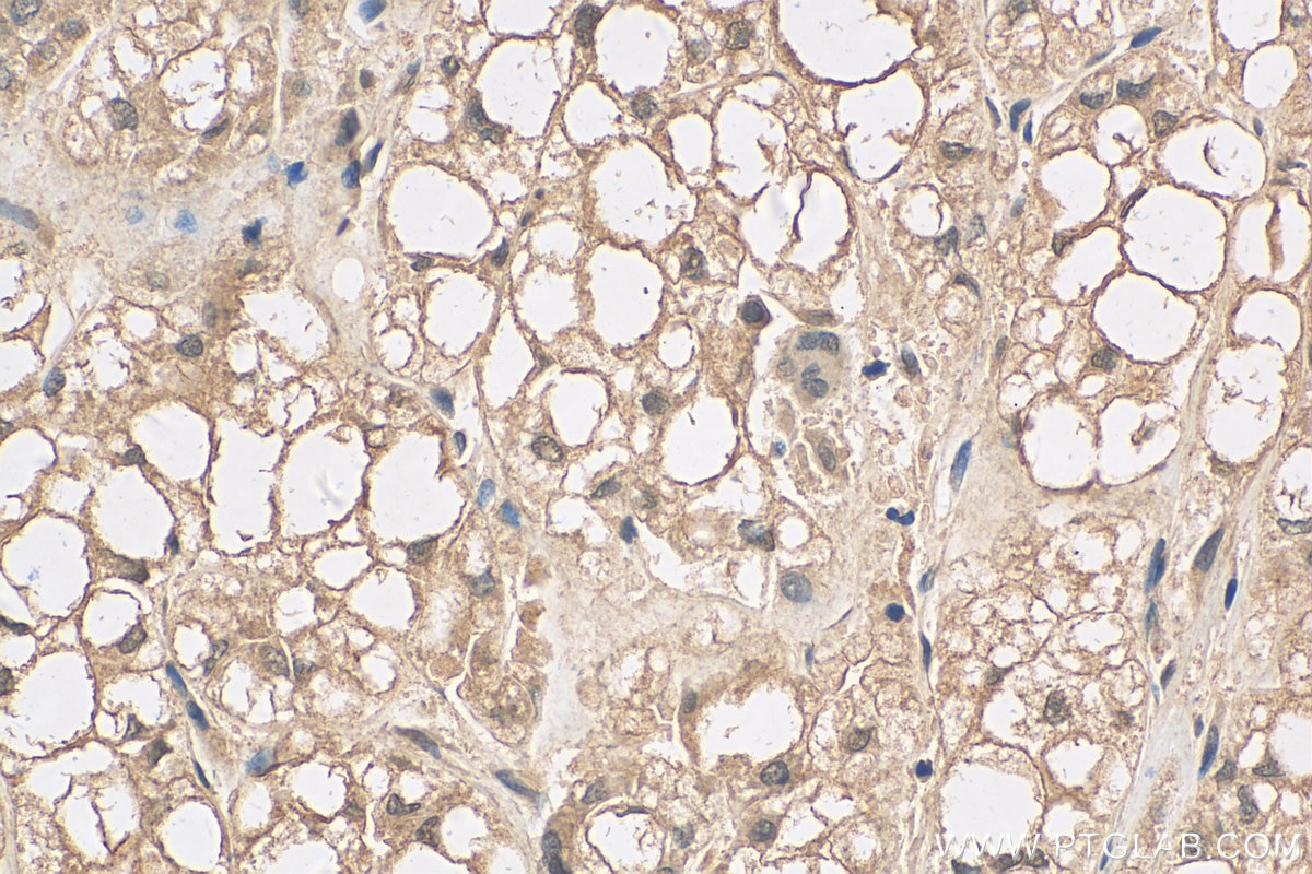 Immunohistochemistry (IHC) staining of human liver cancer tissue using RAP1A Monoclonal antibody (68125-1-Ig)