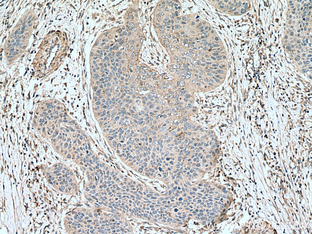Immunohistochemistry (IHC) staining of human oesophagus cancer tissue using RAP1B Polyclonal antibody (10840-1-AP)