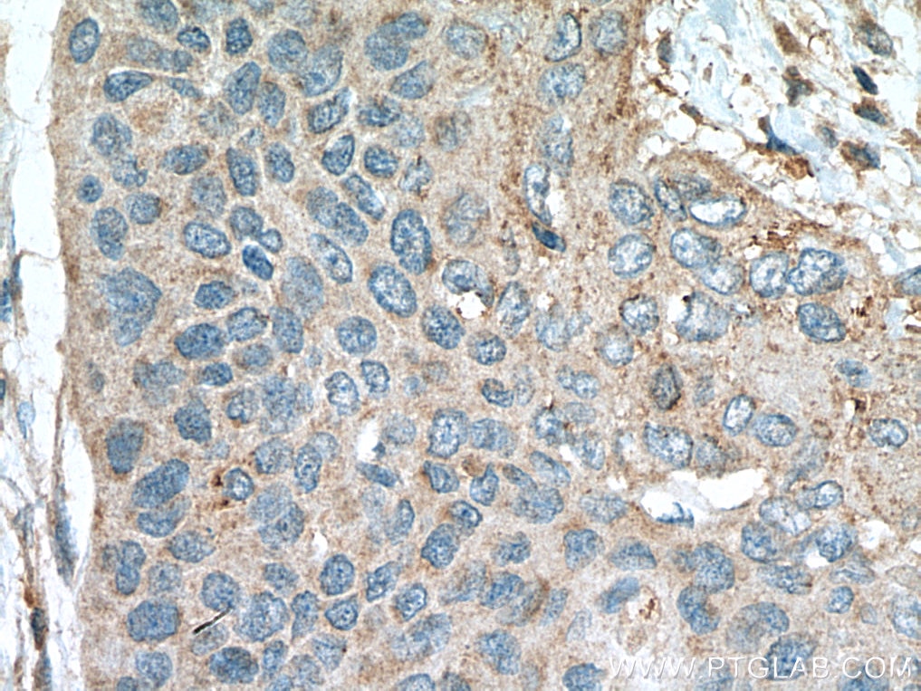 Immunohistochemistry (IHC) staining of human oesophagus cancer tissue using RAP1B Polyclonal antibody (10840-1-AP)