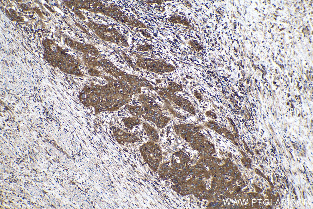 Immunohistochemistry (IHC) staining of human oesophagus cancer tissue using RAP1B Monoclonal antibody (67174-1-Ig)