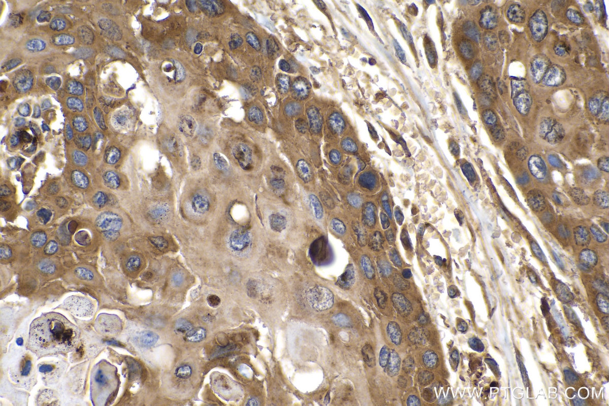 IHC staining of human oesophagus cancer using 67174-1-Ig