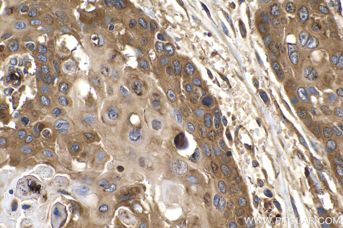 Immunohistochemistry (IHC) staining of human oesophagus cancer tissue using RAP1B Monoclonal antibody (67174-1-Ig)