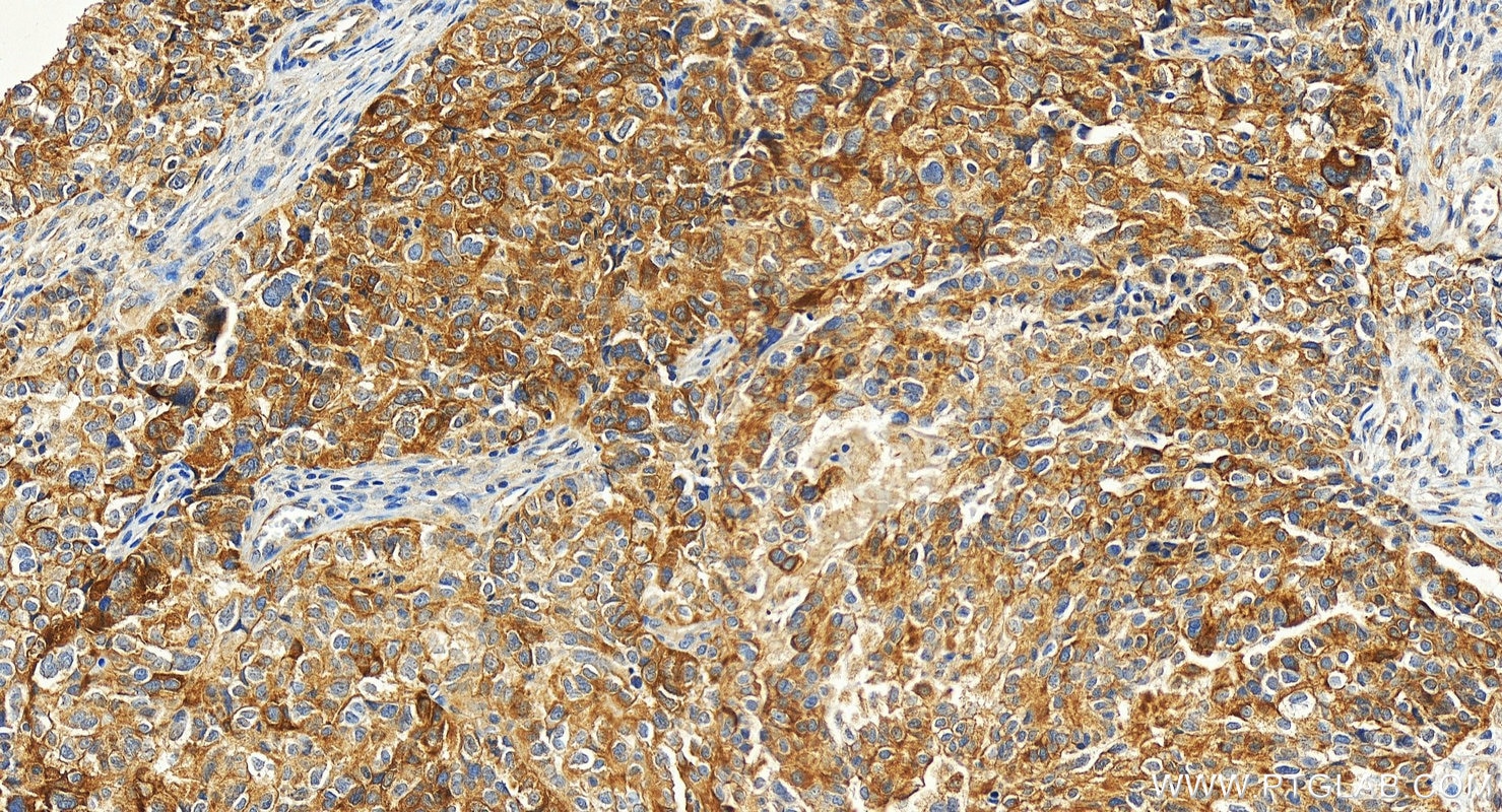 Immunohistochemistry (IHC) staining of human ovary cancer tissue using RAP1GAP Recombinant antibody (86011-2-RR)