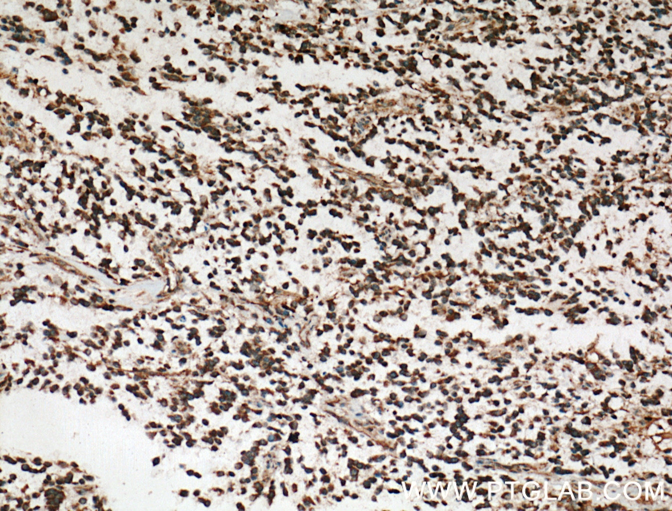 Immunohistochemistry (IHC) staining of human gliomas tissue using RAP1GDS1 Polyclonal antibody (10377-1-AP)
