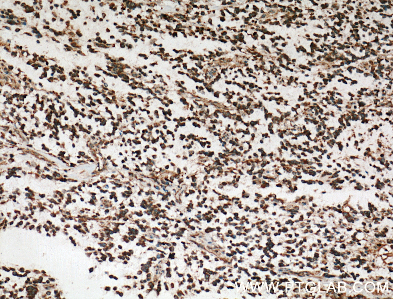 IHC staining of human gliomas using 10377-1-AP