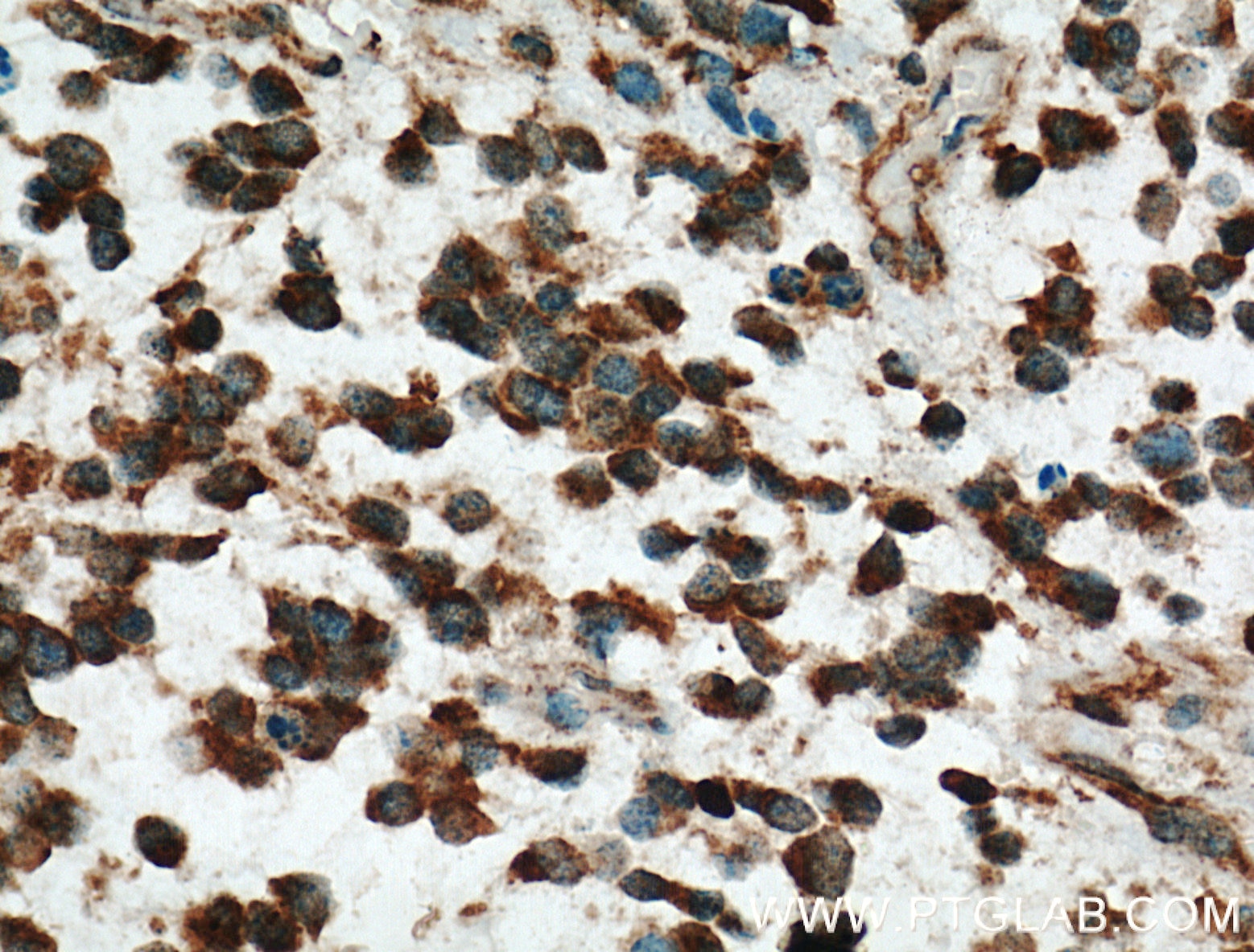 Immunohistochemistry (IHC) staining of human gliomas tissue using RAP1GDS1 Polyclonal antibody (10377-1-AP)