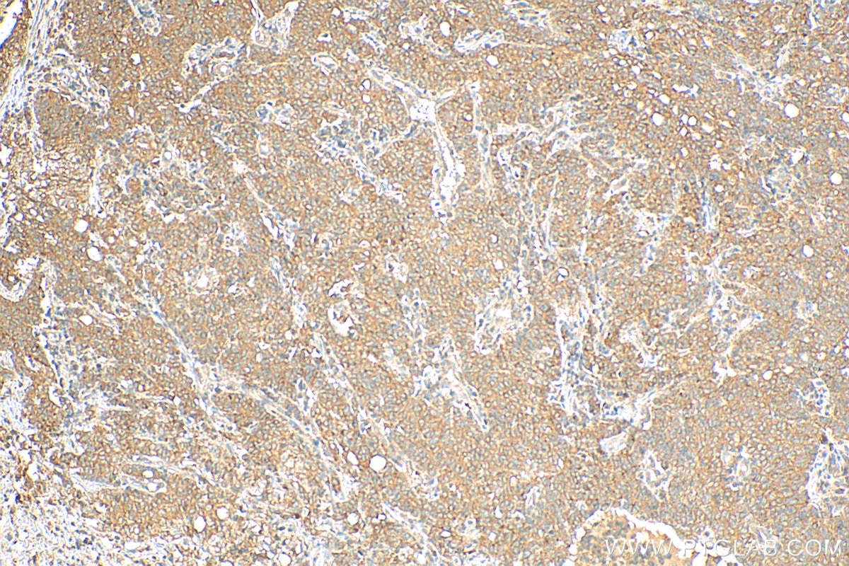 Immunohistochemistry (IHC) staining of human stomach cancer tissue using EPAC1 Polyclonal antibody (12572-1-AP)