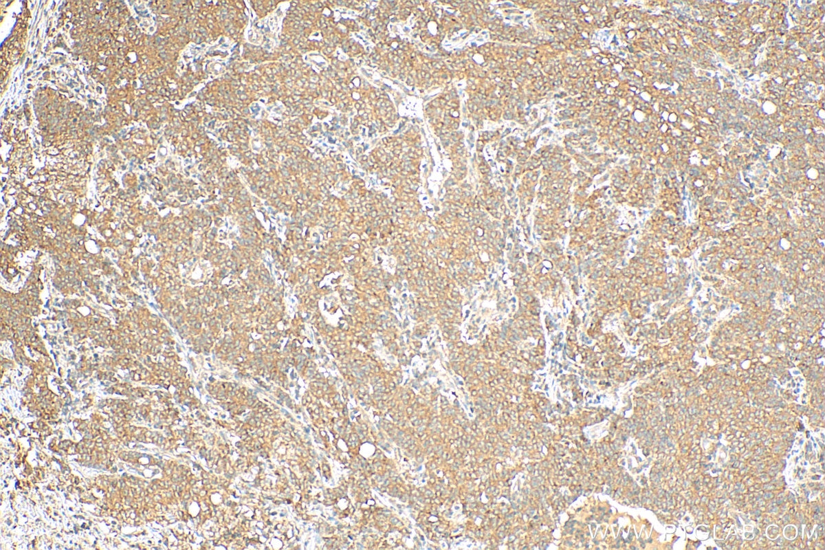 IHC staining of human stomach cancer using 12572-1-AP