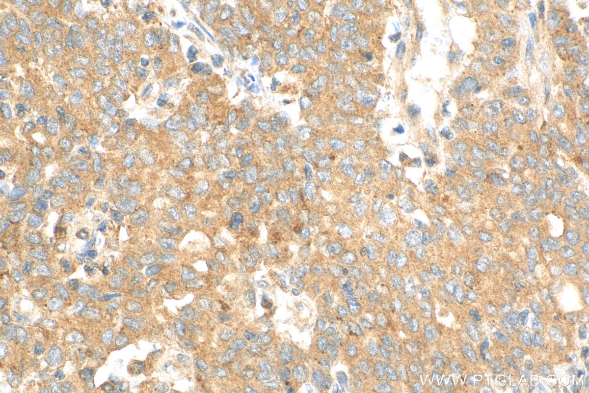 Immunohistochemistry (IHC) staining of human stomach cancer tissue using EPAC1 Polyclonal antibody (12572-1-AP)