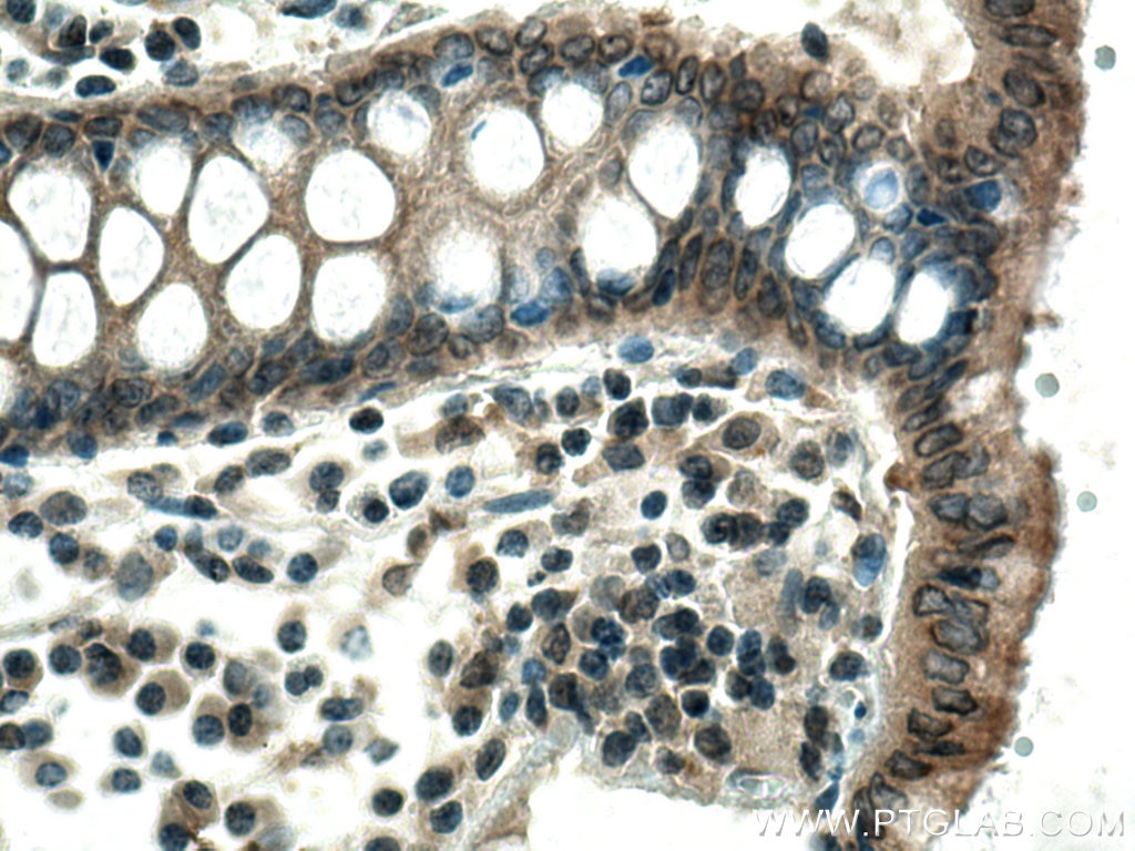 Immunohistochemistry (IHC) staining of human colon cancer tissue using RARA Polyclonal antibody (10331-1-AP)