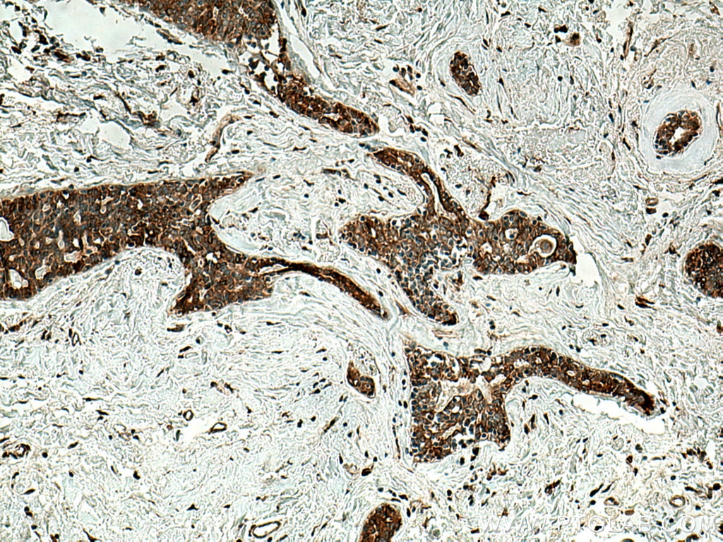 Immunohistochemistry (IHC) staining of human breast cancer tissue using RARA Polyclonal antibody (10331-1-AP)