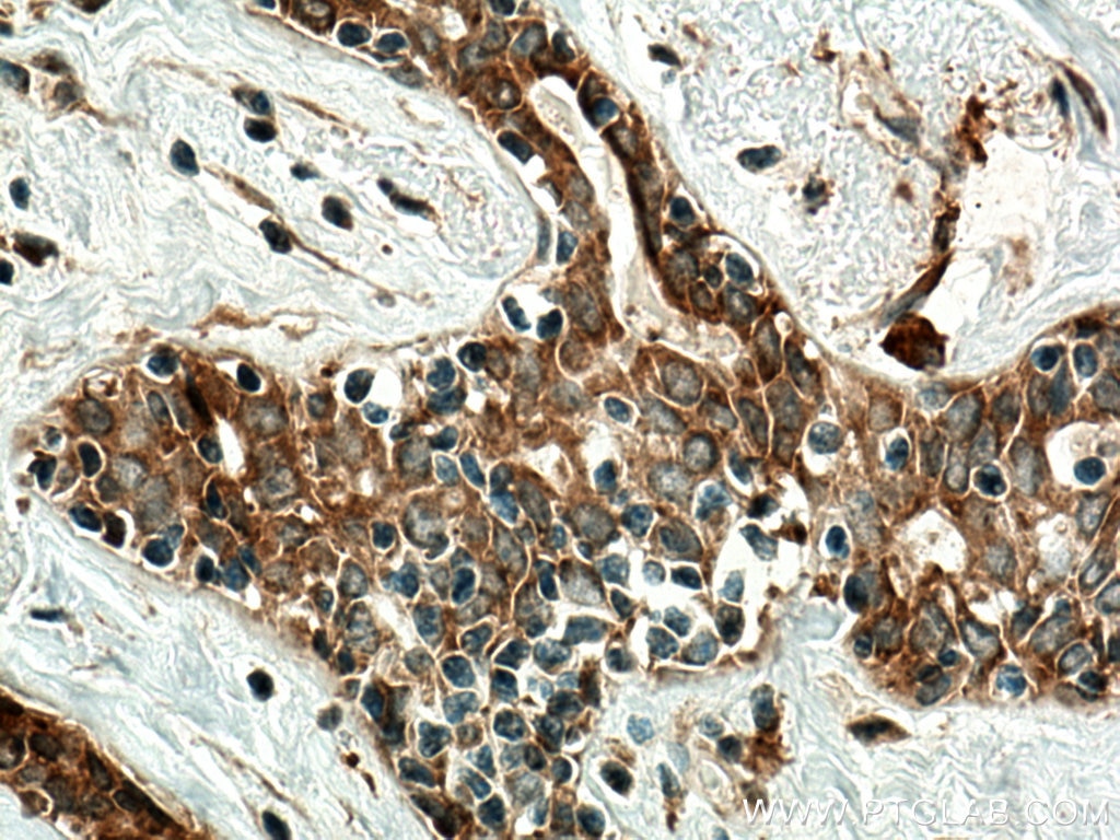 Immunohistochemistry (IHC) staining of human breast cancer tissue using RARA Polyclonal antibody (10331-1-AP)