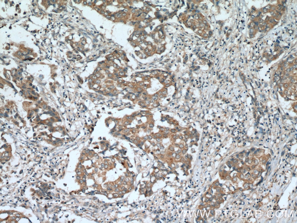 Immunohistochemistry (IHC) staining of human breast cancer tissue using RARA Polyclonal antibody (10331-1-AP)