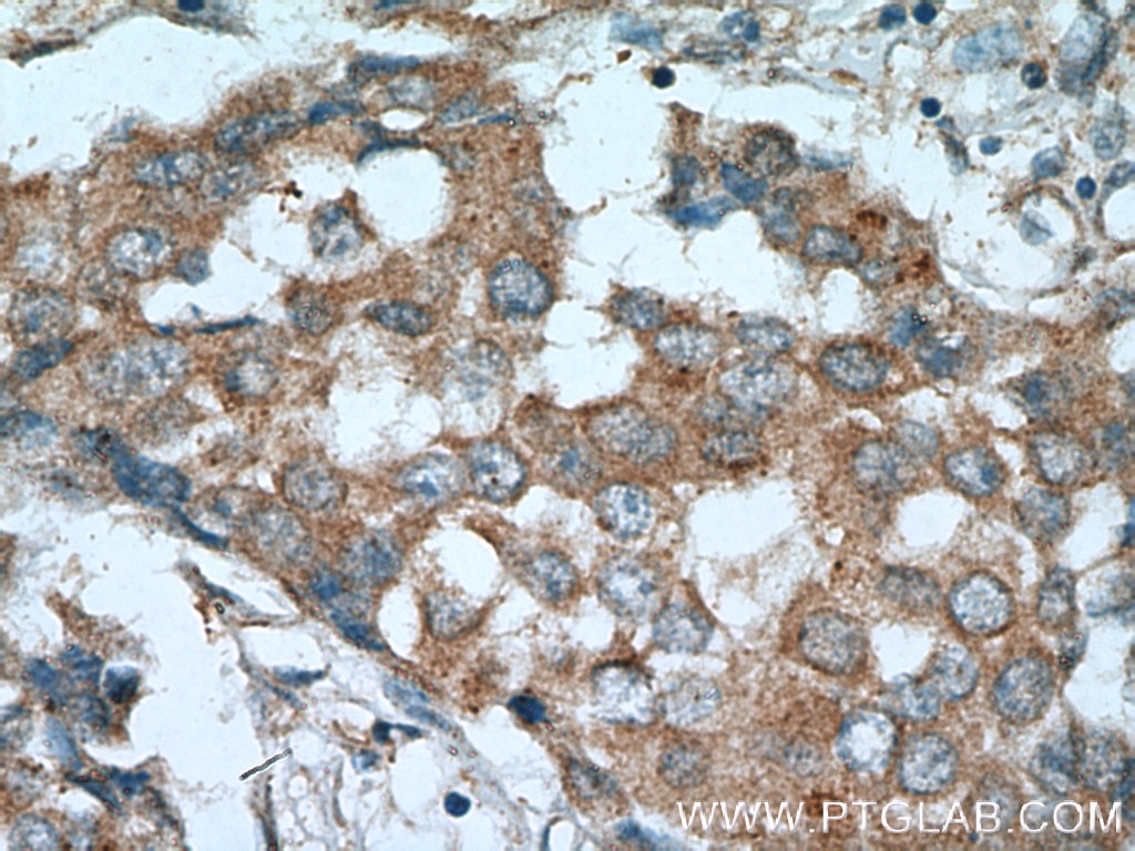 Immunohistochemistry (IHC) staining of human breast cancer tissue using RARA Polyclonal antibody (10331-1-AP)