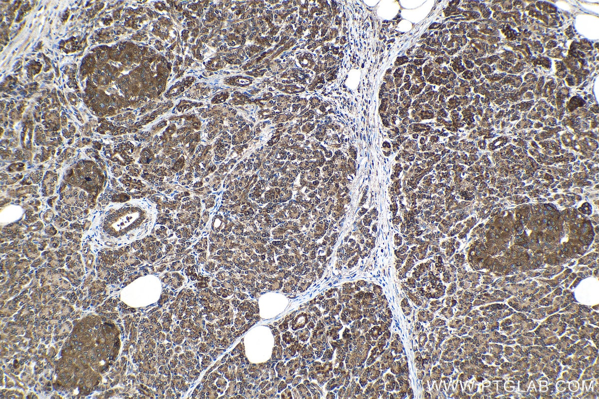 Immunohistochemistry (IHC) staining of human pancreas cancer tissue using RARB Polyclonal antibody (14013-1-AP)