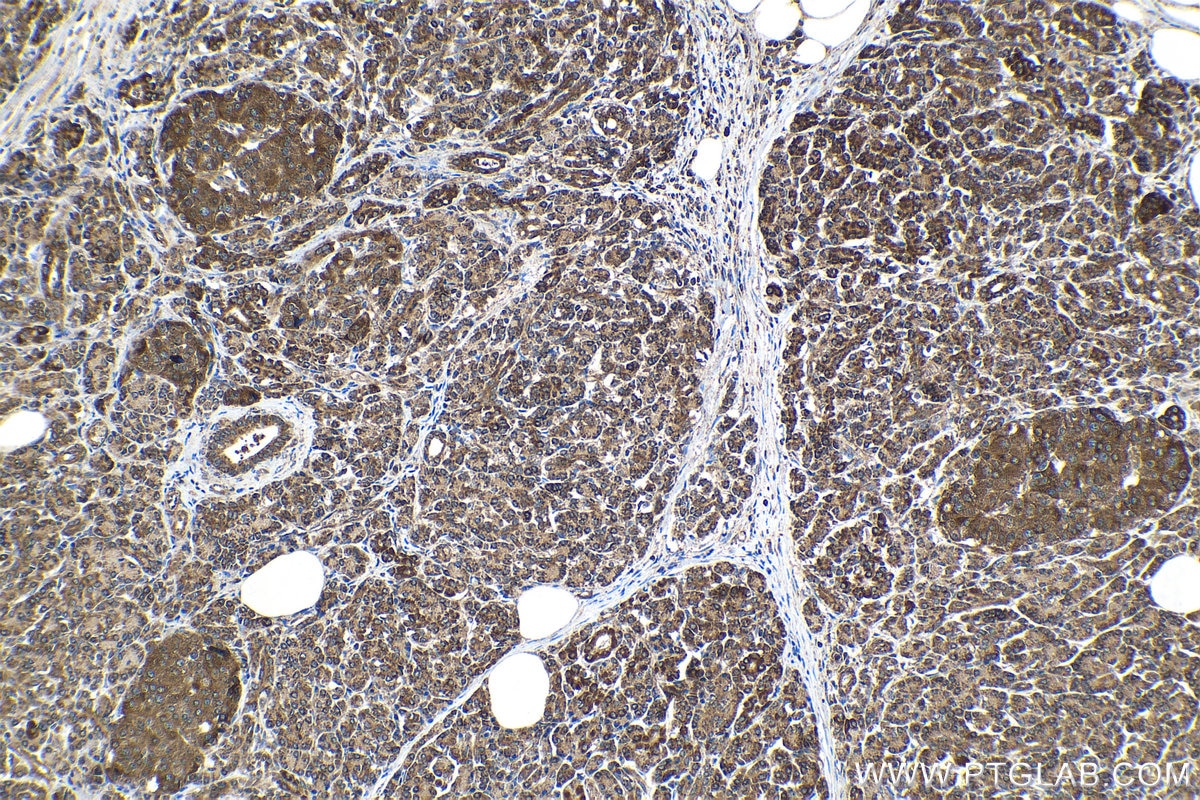 IHC staining of human pancreas cancer using 14013-1-AP