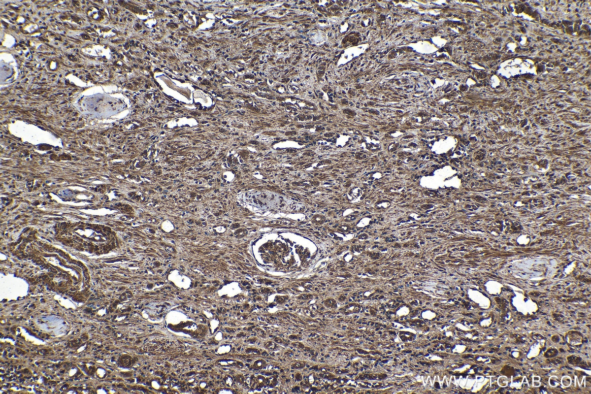 Immunohistochemistry (IHC) staining of human renal cell carcinoma tissue using RARB Polyclonal antibody (14013-1-AP)